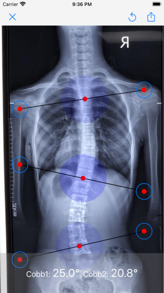 脊柱侧弯cobb角测量软件下载_脊柱侧弯cobb角测量2022版下载v1.0 安卓版 运行截图2